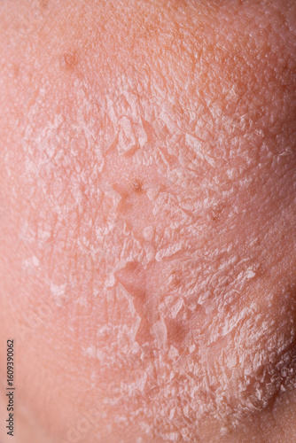 Skin shedding and regeneration close-up – Dermatology concept – Peeling human skin