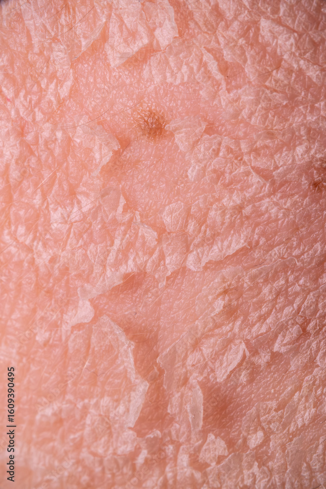 Fototapeta premium Skin shedding and regeneration close-up – Dermatology concept – Peeling human skin