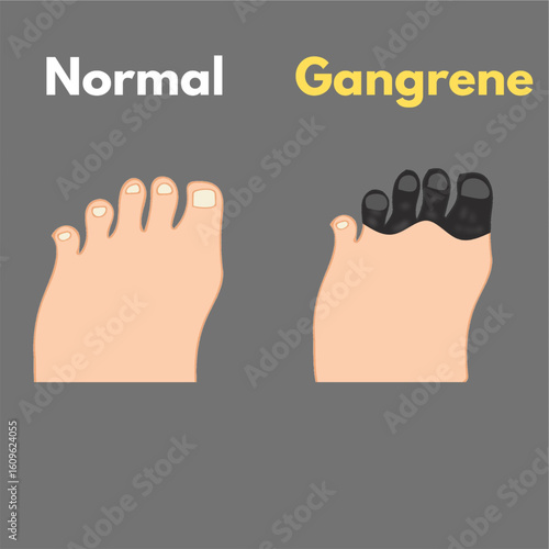 leg gangrene comparison medical illustration leg disease dead tissue due to lack of blood flow.eps