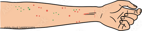 Illustration of hand showing skin irritation with red and green spots  