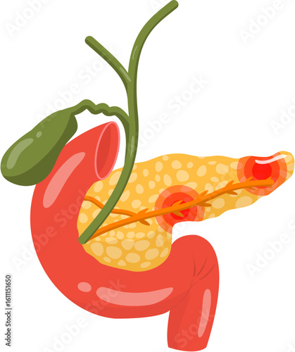 Pancreatitis 