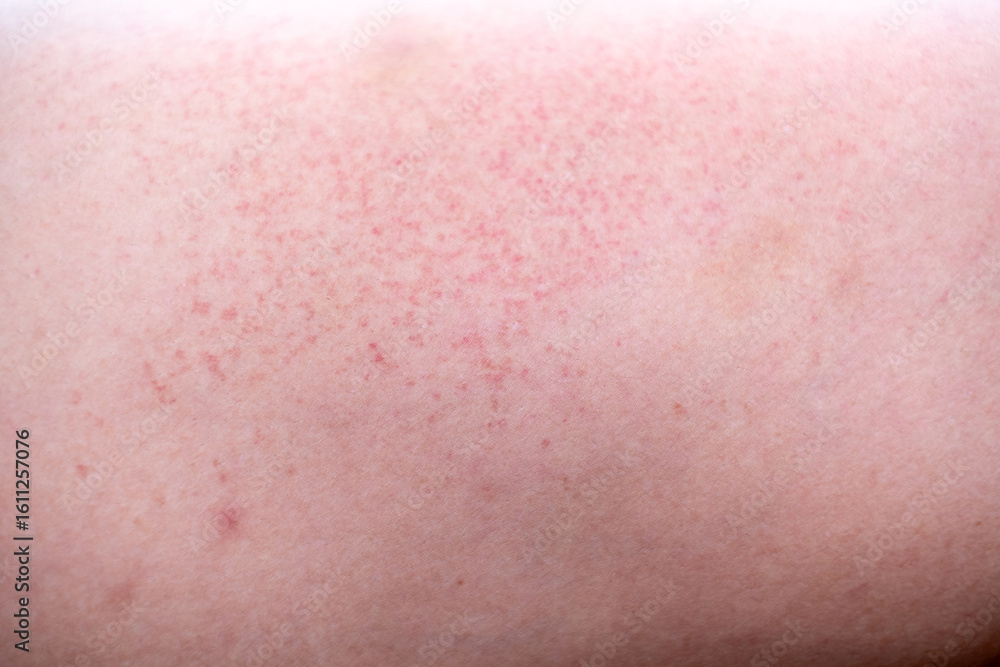 Fototapeta premium Close up of irritated human skin with red rash and inflammation, suitable for medical, dermatology, allergy, and skincare-related concepts in healthcare or pharmaceutical design.