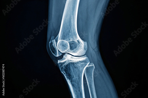 X-ray image of a human knee joint, showcasing bone structure and ligaments