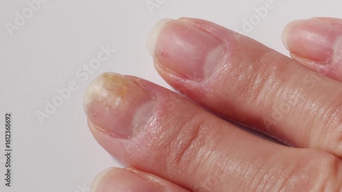 Psoriasis at the nail. Psoriasis is an autoimmune disease that affects the skin and nails. Close up. High quality photo