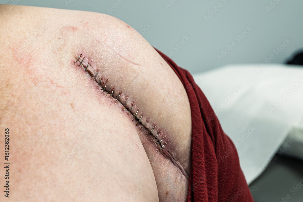 Fototapeta premium Post-Surgery Shoulder with Surgical Staples and Healing Incision