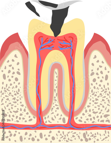 Tooth decay