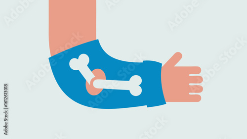 Illustration of a broken arm with a blue cast showing the fractured bones inside