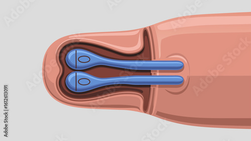 Illustration of a medical implant placed inside a human body for health purposes