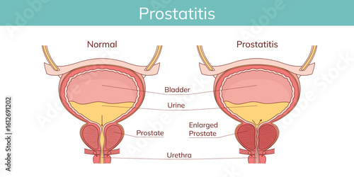Benign prostatic hyperplasia (BPH). Comparison between normal prostate and enlarged prostate. Male reproductive system disease.