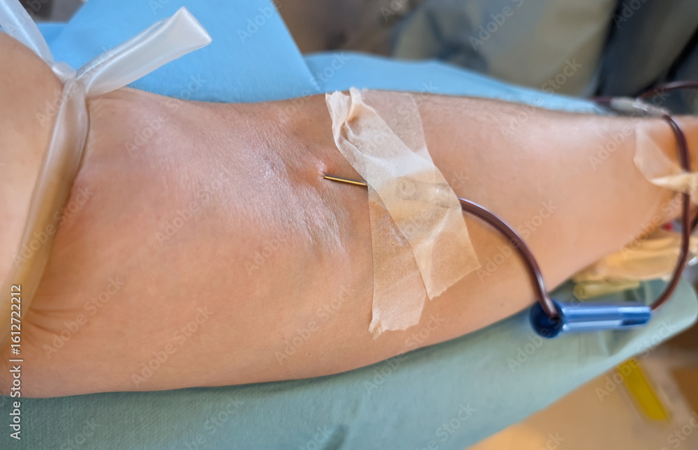 Fototapeta premium blood donors during collection with a tourniquet tightly constri