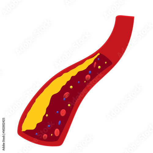 blocked arterial blood vessel blood flow plaque build up cholesterol bad thrombosis blockage.eps