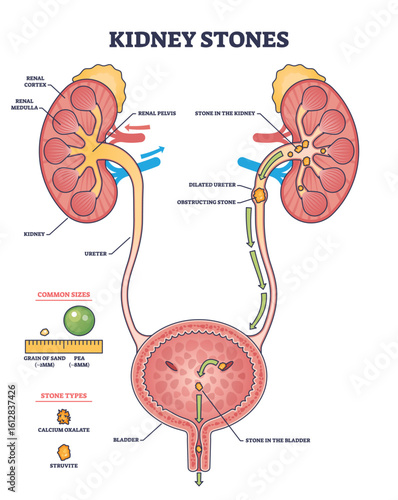 Kidney stones diagram shows kidneys, ureters, and bladder with stone locations and flow path. Outline diagram