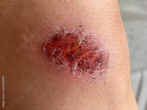 Photography Close-Up of Skin Lesion on Human Knee – Medical Reference Photo