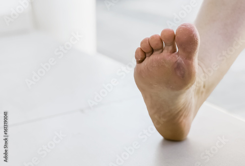 Obraz na plátně Foot with blister or chafing caused by uncomfortable shoes, showing skin irritat
