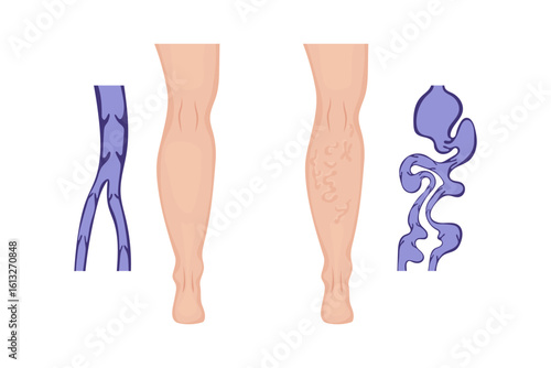 Comparing healthy leg veins with varicose veins and their internal structure