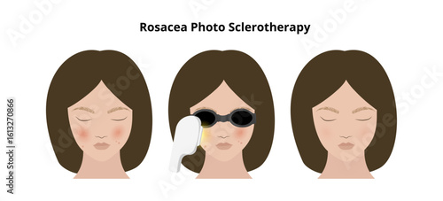 Woman undergoing rosacea photosclerotherapy treatment for facial redness