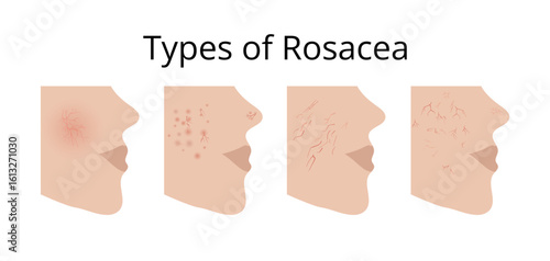 Four types of rosacea showing different symptoms on face skin