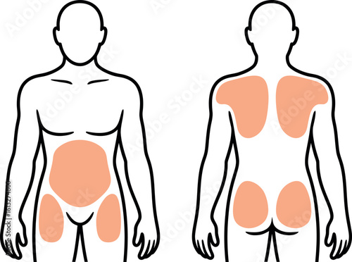 Illustration showing body areas for fat transfer on front and back view of a person outline