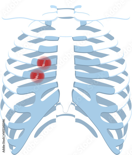 Costae fracture