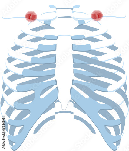 Clavicle  fracture 