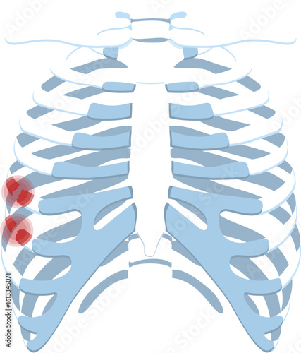 Costae fracture