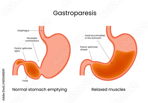 Gastroparesis Normal Stomach Emptying vs. Relaxed Muscles