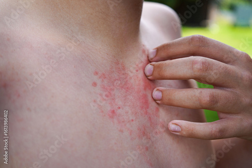 A boy rubs his hand over skin rashes resulting from allergies or hives. Skin conditions, dermatology.