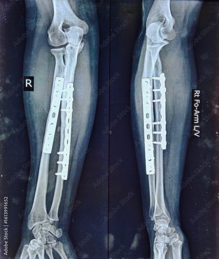 Εκτύπωση καμβά Post operative x-ray of radius and ulna fracture showing fixation by plate and screw