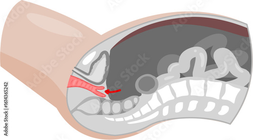 Vault prolapse 