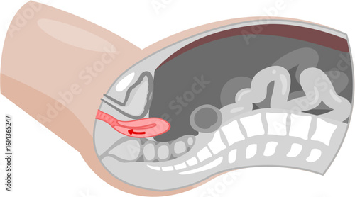 Uterine prolapse 