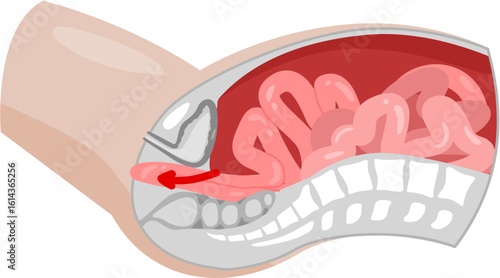 Small bowel prolapse 