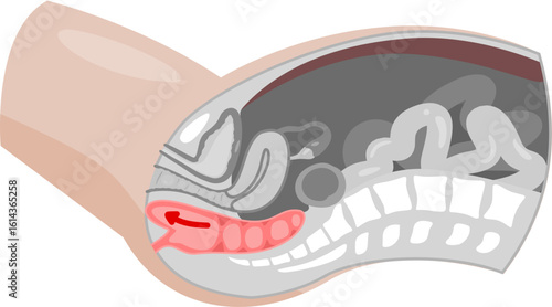 Rectal prolapse 