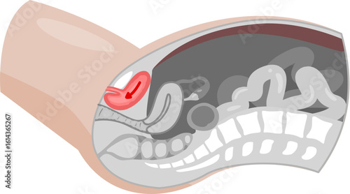 Bladder prolapse