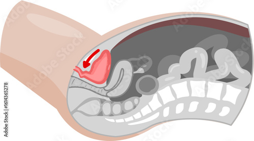 Urethral prolapse 