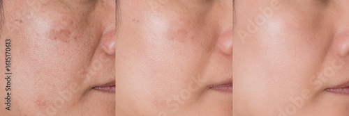 cropped Image before and after spot melasma pigmentation treatment on skin face asian woman compare in 3 development periods. Skincare and beauty concept