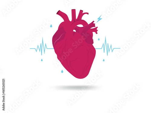 Heart attack causing chest pain and arrhythmia with weak pulse