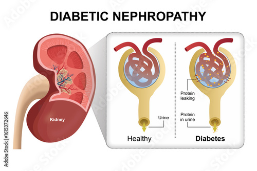 Diabetic Nephropathy (Kidney Disease)