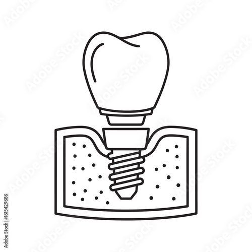 Dental implant icon showing a tooth restoration procedure for oral surgery and stomatology to replace a missing tooth with a crown line vector stroke
