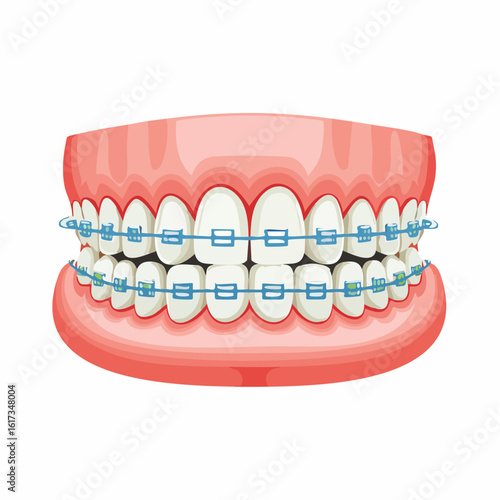 Vector illustration of teeth with dental braces