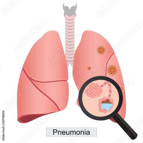Pneumonia is an inflammatory condition of the lung.