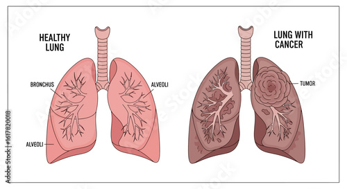 Vector Illustration of Healthy Lungs and Lungs with Cancer in Modern Style with Pink and Brown Coloring