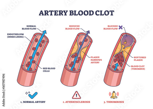 Artery blood clot diagram shows normal artery, atherosclerosis, and thrombosis stages with blood flow, plaque, and clot. Outline diagram