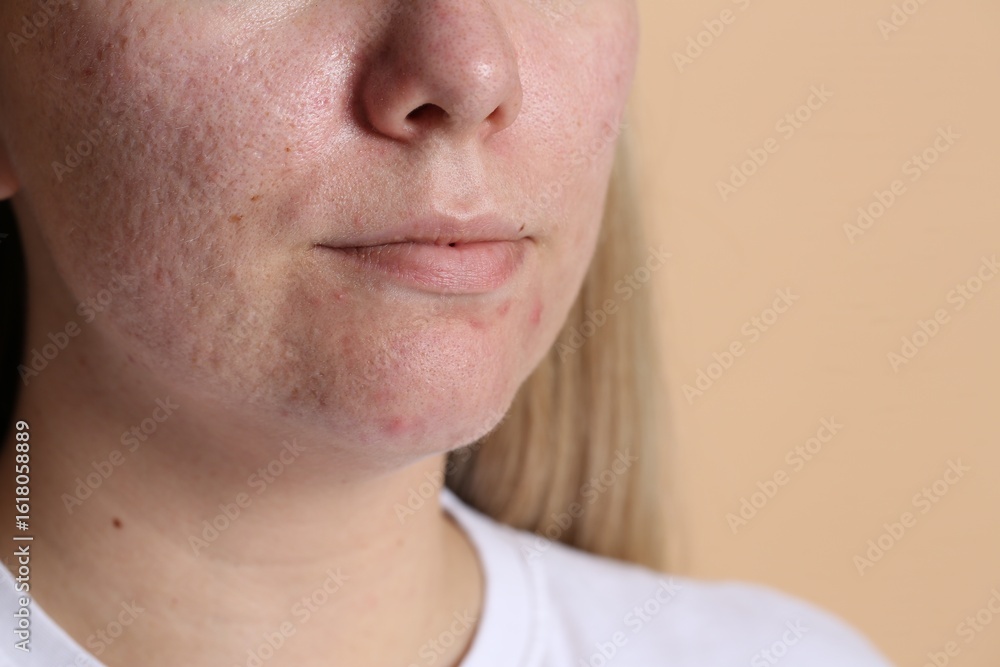 Fototapeta premium Woman with acne problem on beige background, closeup. Space for text