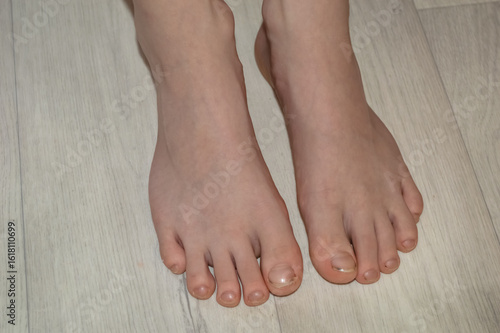 child's feet with uncut and dirty nails