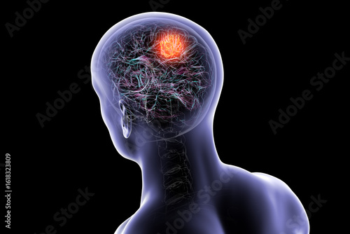 Foto Brain tumor, 3D illustration
