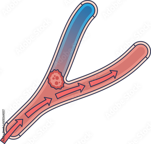 Medical illustration of a blood clot (thrombus) blocking an artery at a bifurcation. Arrows show blood flow being obstructed, representing thrombosis or embolism and the risk of ischemia.