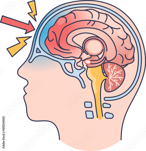 Medical illustration of a brain contusion. An arrow shows an impact on the head, causing bruising and swelling of the brain tissue inside the skull, representing a traumatic brain injury.