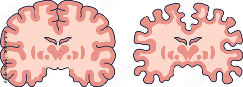 Illustration comparing a healthy brain cross-section to one with significant brain volume loss, showing cerebral atrophy and the effects of neurodegeneration.