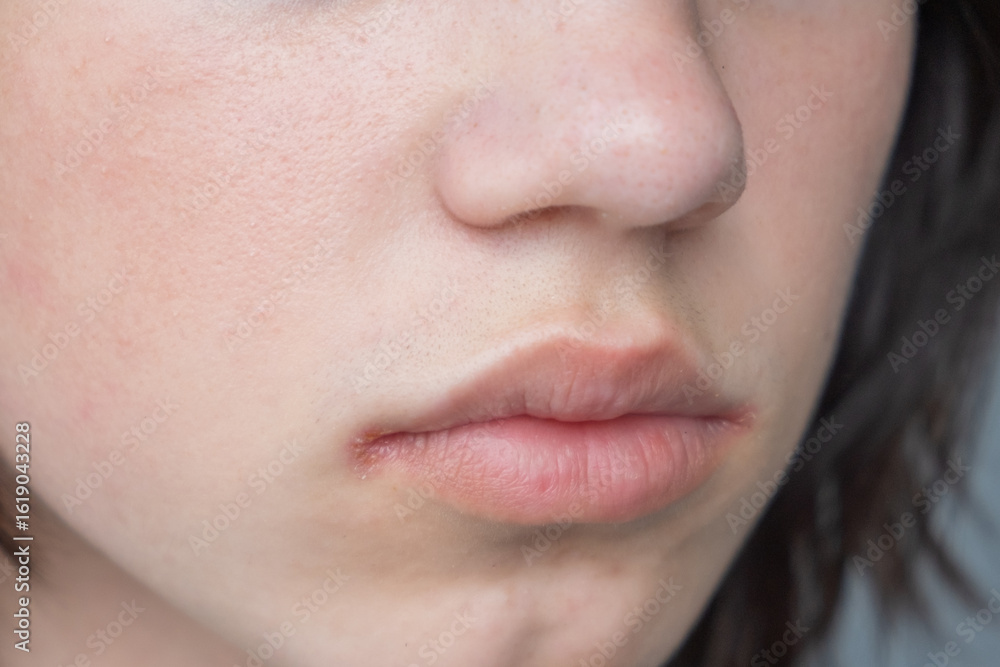 Obraz premium Close-up of ulcers on the lips with signs of pain and itching in the corners