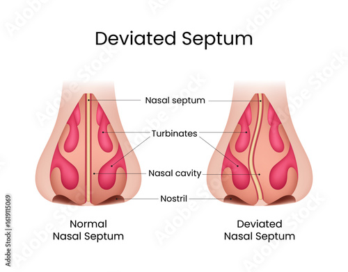 Normal Nasal Septum vs Deviated Nasal Septum